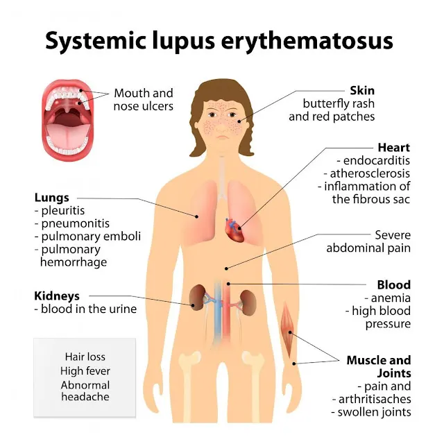 Lupus (SLE) Symptoms, Treatment and experience Lupus (SLE) Symptoms, Treatment and experience