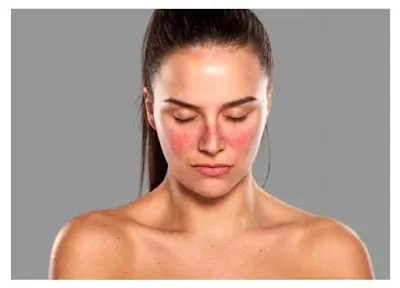 Understand Lupus (SLE) an inflammatory disease that has no cure yet Understand Lupus (SLE) an inflammatory disease that has no cure yet